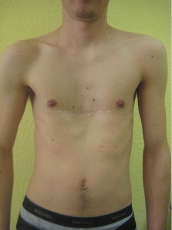 Trichterbrust Zentrum Düsseldorf rezidiv1 - Trichterbrust Zentrum ...